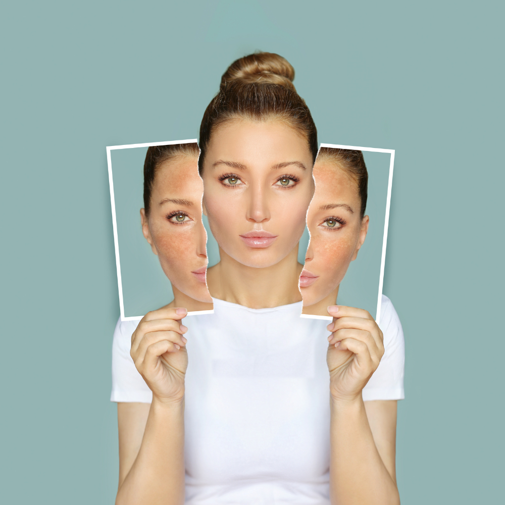 Skin Discolouration and Pigmentation