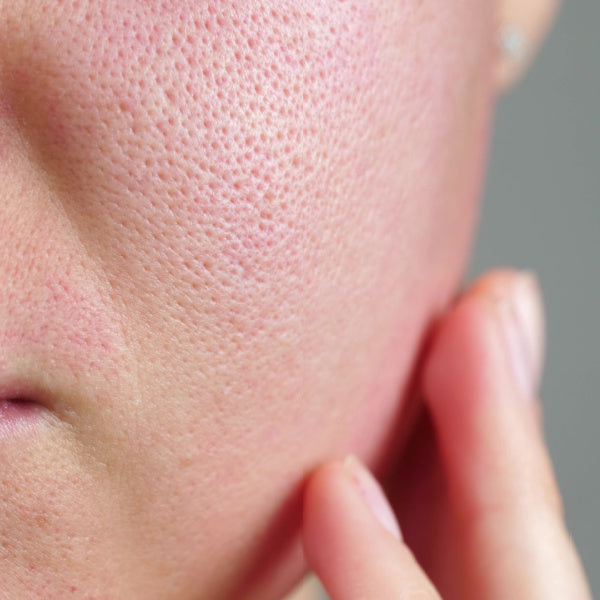 Experience Pore-fection: Minimise Enlarged Pores with SKIN1004