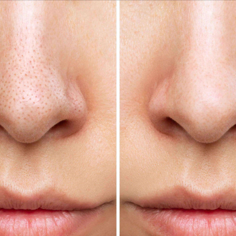 Bye Bye Blackheads and Whiteheads - Simple Steps for Achieving Spotless Skin